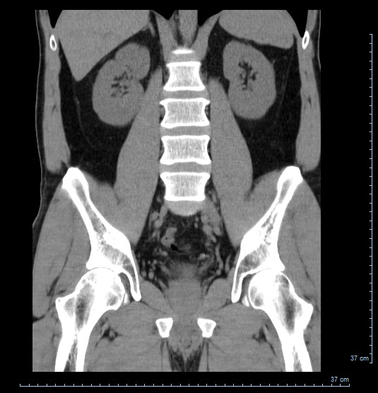 CT scan, 17 May 2011 (it doesn't show anything wrong)